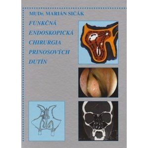 Funkčná endoskopická chirurgia prinosových dutín
